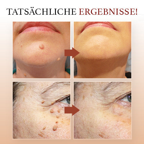DermaPure Huidlabels Verwijderaar – Pijnloze & Veilige Oplossing voor Een Egale Huid
