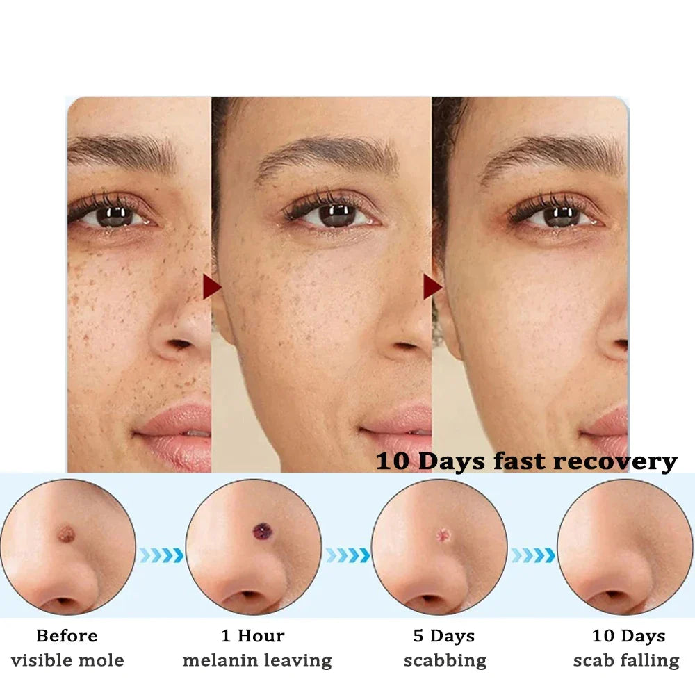 ClearSkin Vlekkenverwijderaar – Pijnloos & Effectief voor Thuis